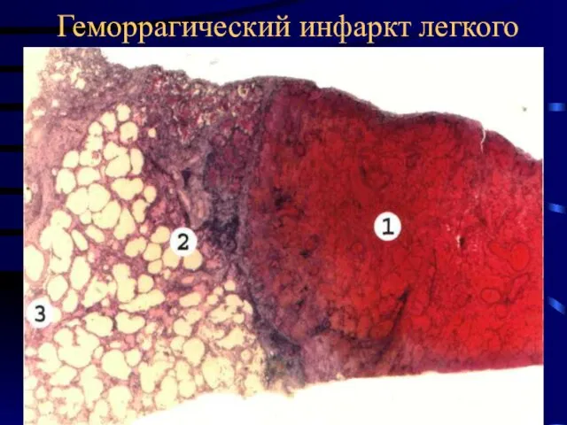 Геморрагический инфаркт легкого