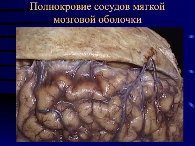 Полнокровие сосудов мягкой мозговой оболочки