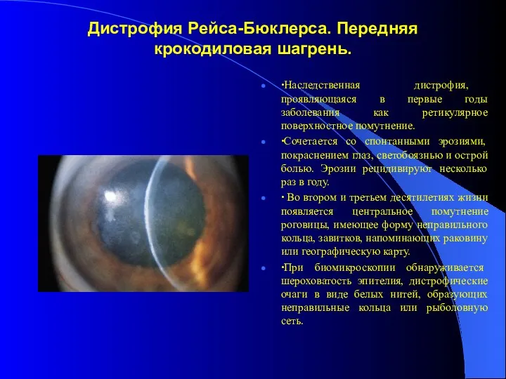 Дистрофия Рейса-Бюклерса. Передняя крокодиловая шагрень. ∙Наследственная дистрофия, проявляющаяся в первые