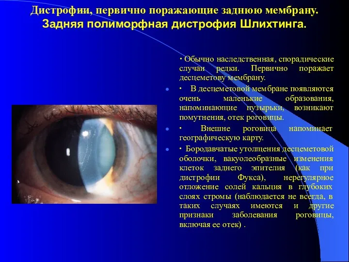 Дистрофии, первично поражающие заднюю мембрану. Задняя полиморфная дистрофия Шлихтинга. ∙