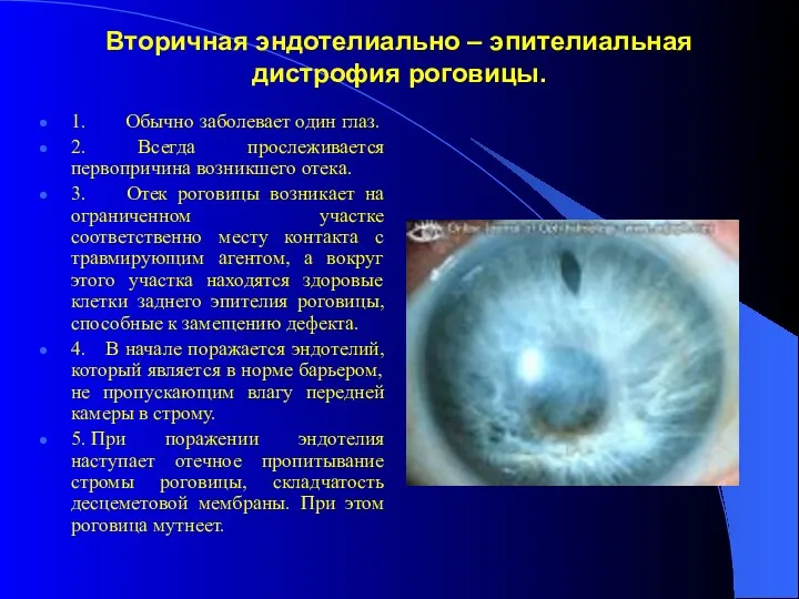 Вторичная эндотелиально – эпителиальная дистрофия роговицы. 1. Обычно заболевает один