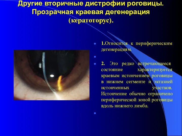 Другие вторичные дистрофии роговицы. Прозрачная краевая дегенерация (кератоторус). 1.Относится к