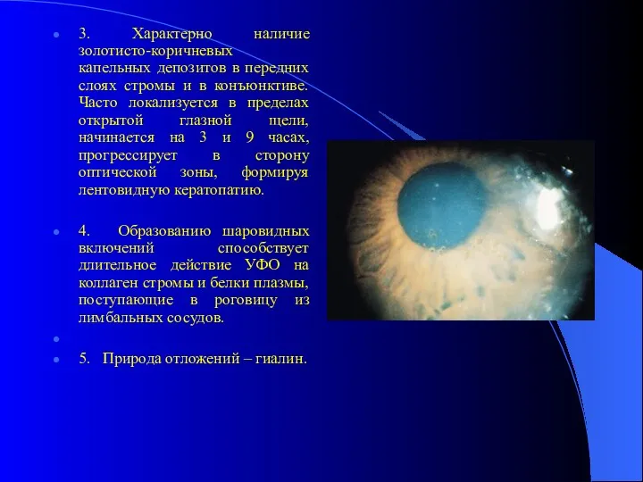 3. Характерно наличие золотисто-коричневых капельных депозитов в передних слоях стромы