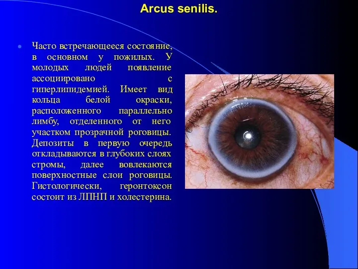 Arcus senilis. Часто встречающееся состояние, в основном у пожилых. У