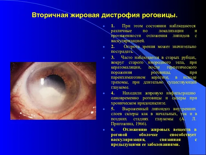 Вторичная жировая дистрофия роговицы. 1. При этом состоянии наблюдаются различные