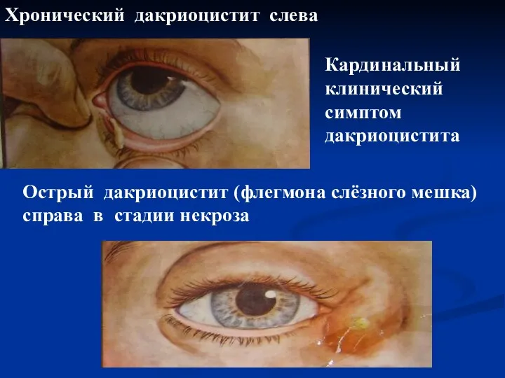 Хронический дакриоцистит слева Кардинальный клинический симптом дакриоцистита Острый дакриоцистит (флегмона слёзного мешка) справа в стадии некроза