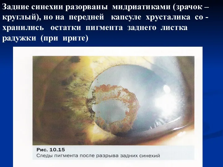 Задние синехии разорваны мидриатиками (зрачок – круглый), но на передней капсуле хрусталика со