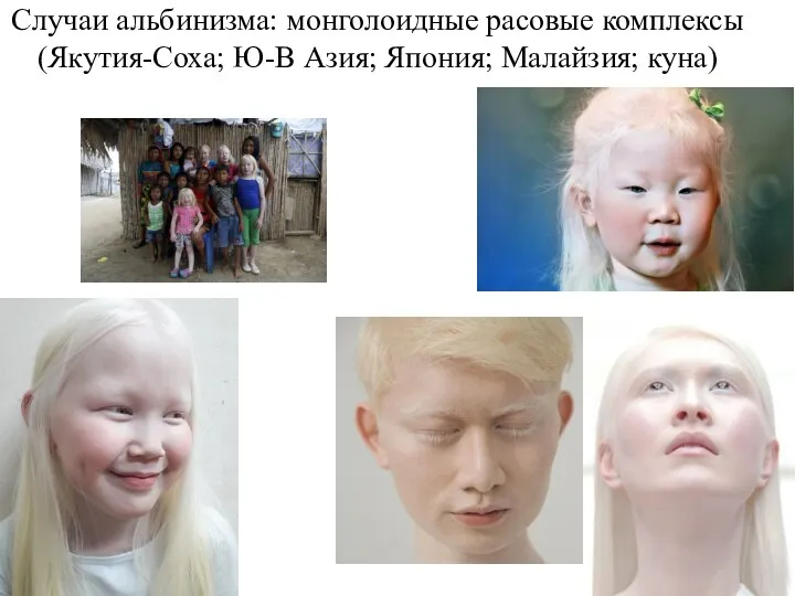 Случаи альбинизма: монголоидные расовые комплексы (Якутия-Соха; Ю-В Азия; Япония; Малайзия; куна)