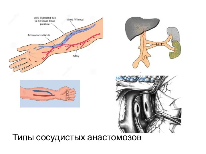 Типы сосудистых анастомозов