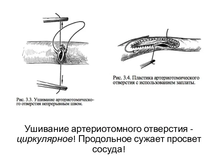 Ушивание артериотомного отверстия - циркулярное! Продольное сужает просвет сосуда!