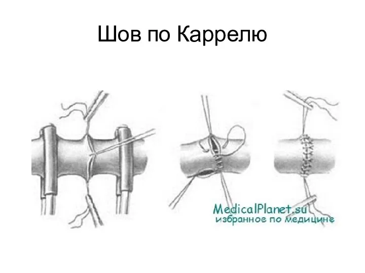 Шов по Каррелю