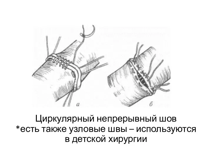 Циркулярный непрерывный шов *есть также узловые швы – используются в детской хирургии