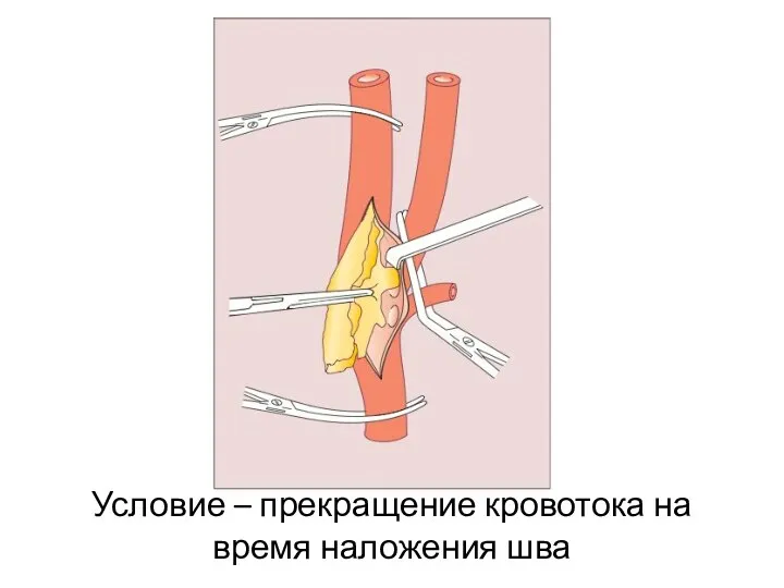 Условие – прекращение кровотока на время наложения шва