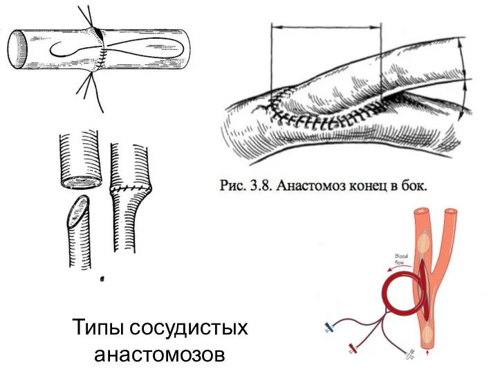 Типы сосудистых анастомозов