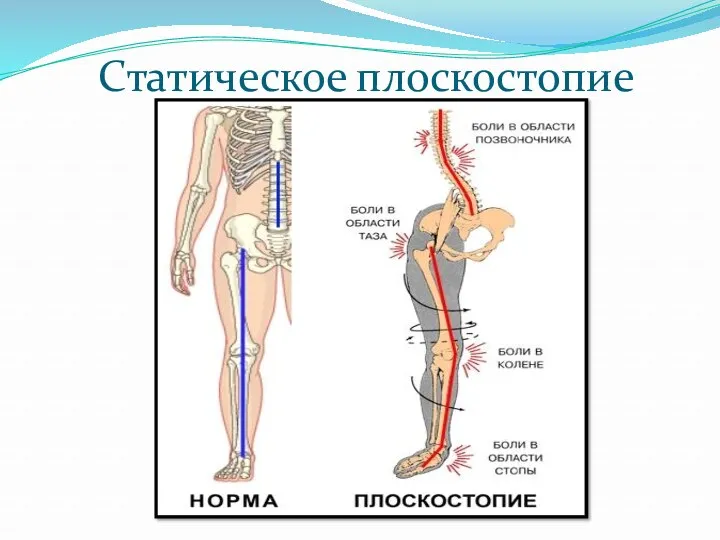 Статическое плоскостопие