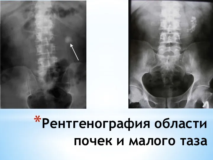 Рентгенография области почек и малого таза