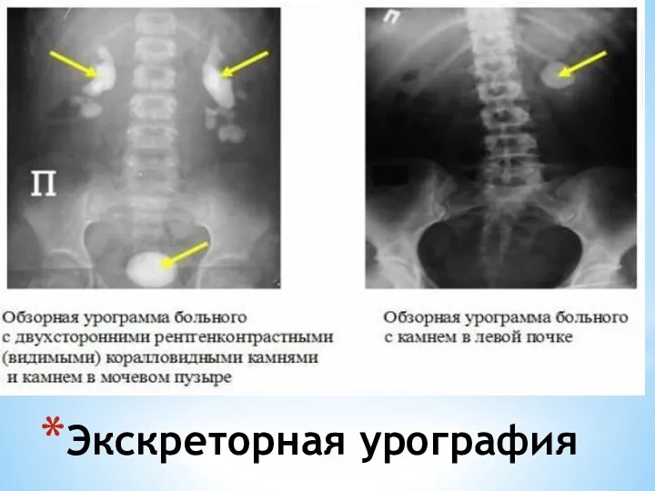 Экскреторная урография