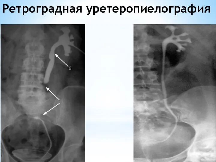 Ретроградная уретеропиелография