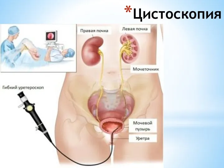 Цистоскопия