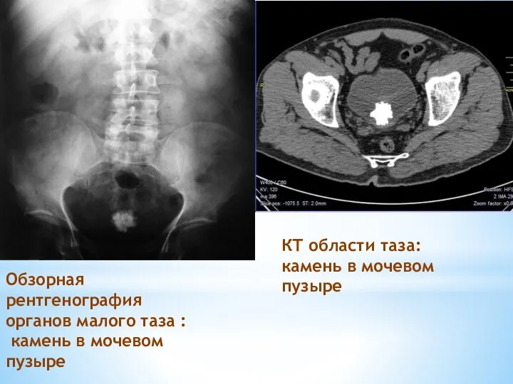 Обзорная рентгенография органов малого таза : камень в мочевом пузыре КТ области таза:
