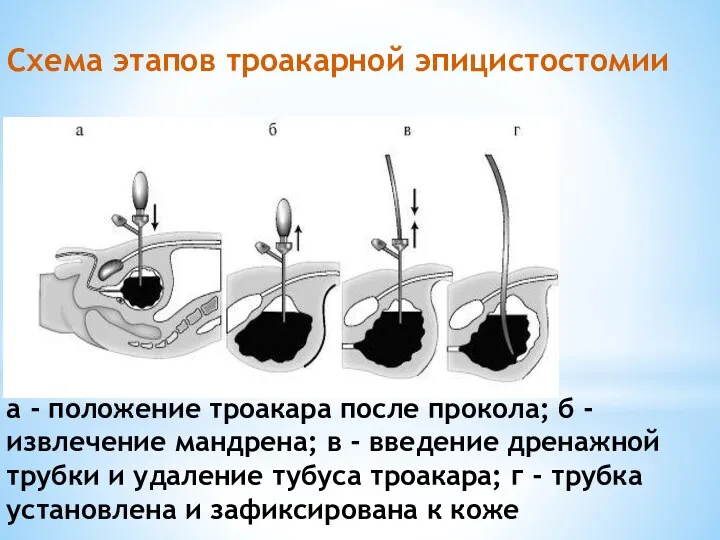 а - положение троакара после прокола; б - извлечение мандрена;