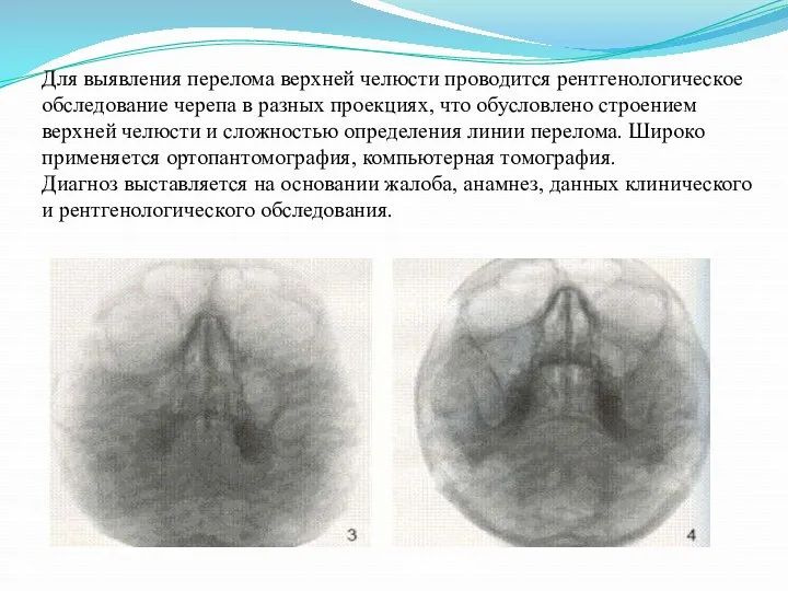 Для выявления перелома верхней челюсти проводится рентгенологическое обследование черепа в