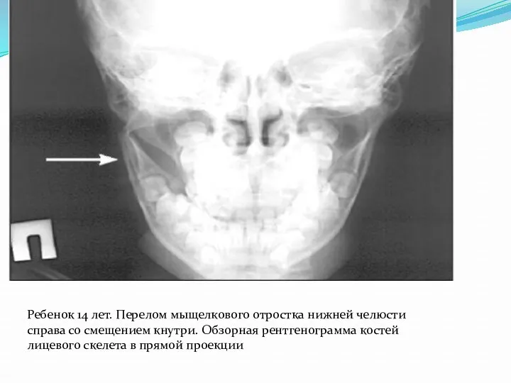 Ребенок 14 лет. Перелом мыщелкового отростка нижней челюсти справа со