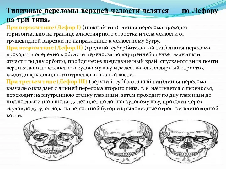 Типичные переломы верхней челюсти делятся по Лефору на три типа.