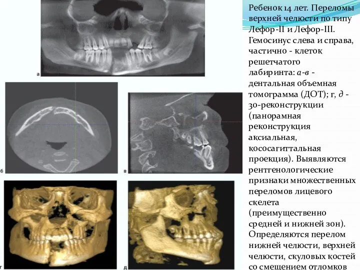 Ребенок 14 лет. Переломы верхней челюсти по типу Лефор-II и