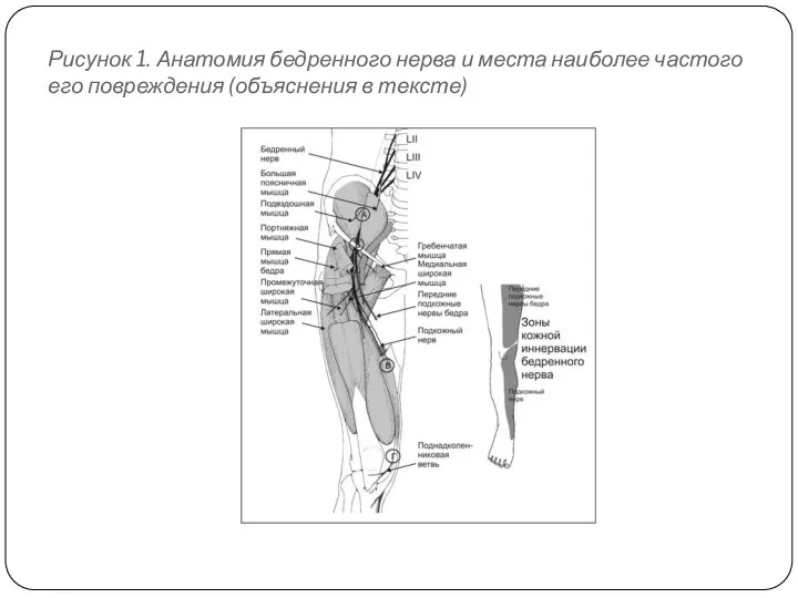 Рисунок 1. Анатомия бедренного нерва и места наиболее частого его повреждения (объяснения в тексте)