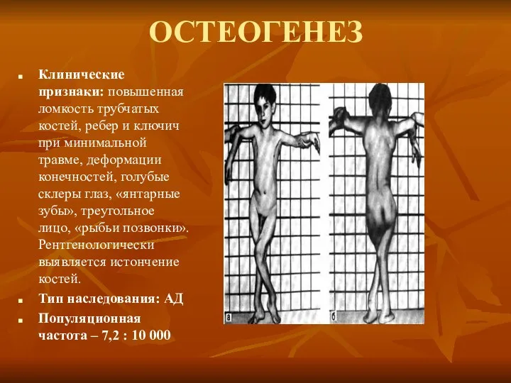 ОСТЕОГЕНЕЗ Клинические признаки: повышенная ломкость трубчатых костей, ребер и ключич