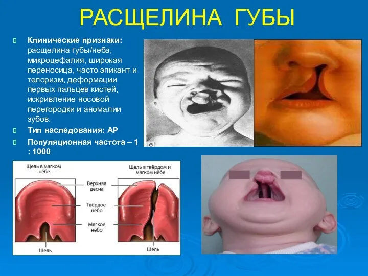 РАСЩЕЛИНА ГУБЫ Клинические признаки: расщелина губы/неба, микроцефалия, широкая переносица, часто