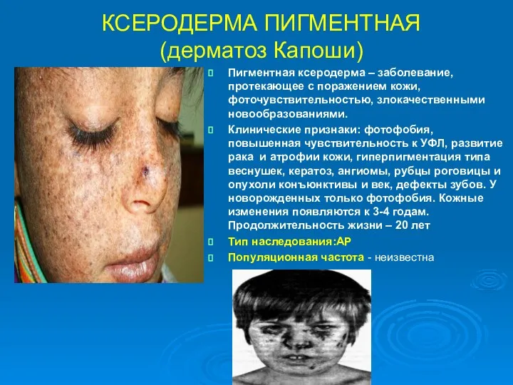 КСЕРОДЕРМА ПИГМЕНТНАЯ (дерматоз Капоши) Пигментная ксеродерма – заболевание, протекающее с поражением кожи, фоточувствительностью,