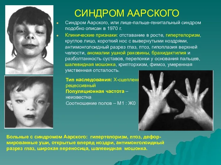 СИНДРОМ ААРСКОГО Синдром Аарского, или лице-пальце-генитальный синдром подобно описан в 1970 г. Клинические