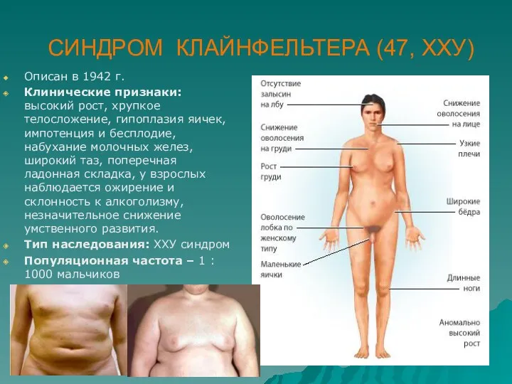 СИНДРОМ КЛАЙНФЕЛЬТЕРА (47, ХХУ) Описан в 1942 г. Клинические признаки: