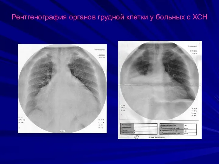 Рентгенография органов грудной клетки у больных с ХСН