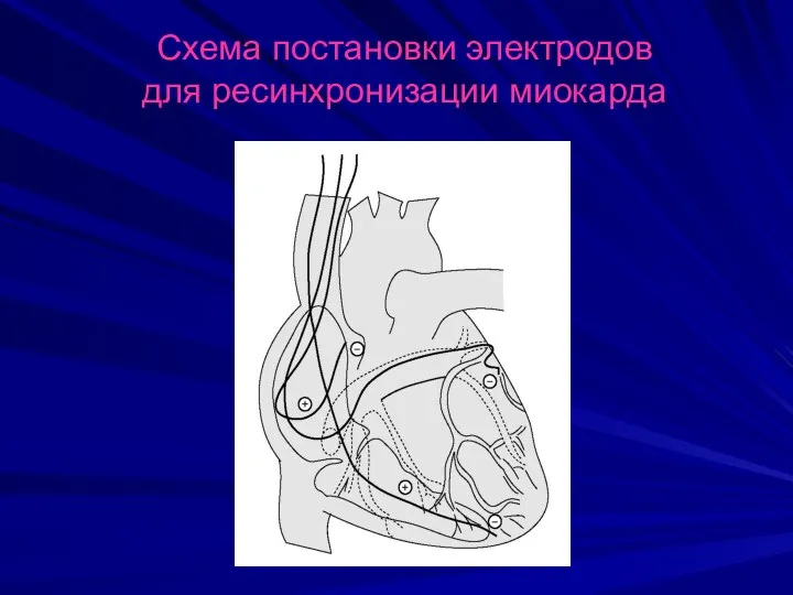 Схема постановки электродов для ресинхронизации миокарда