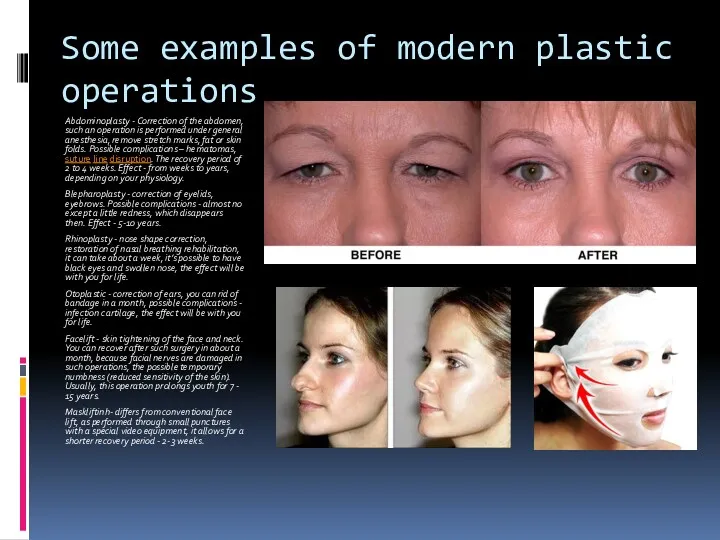 Some examples of modern plastic operations Abdominoplasty - Correction of