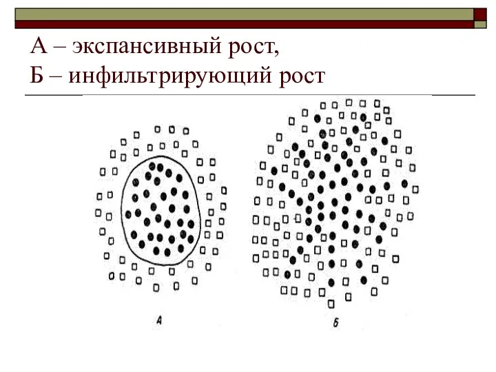 А – экспансивный рост, Б – инфильтрирующий рост