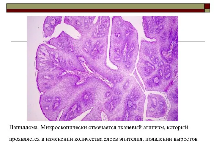 Папиллома. Микроскопически отмечается тканевый атипизм, который проявляется в изменении количества слоев эпителия, появлении выростов.