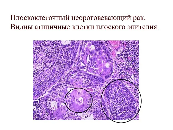 Плоскоклеточный неороговевающий рак. Видны атипичные клетки плоского эпителия.