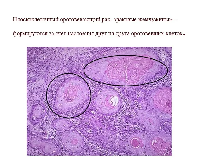 Плоскоклеточный ороговевающий рак. «раковые жемчужины» – формируются за счет наслоения друг на друга ороговевших клеток.