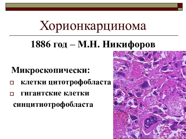 Хорионкарцинома 1886 год – М.Н. Никифоров Микроскопически: клетки цитотрофобласта гигантские клетки синцитиотрофобласта