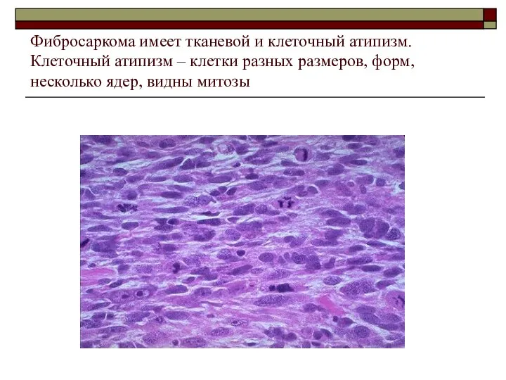 Фибросаркома имеет тканевой и клеточный атипизм. Клеточный атипизм – клетки