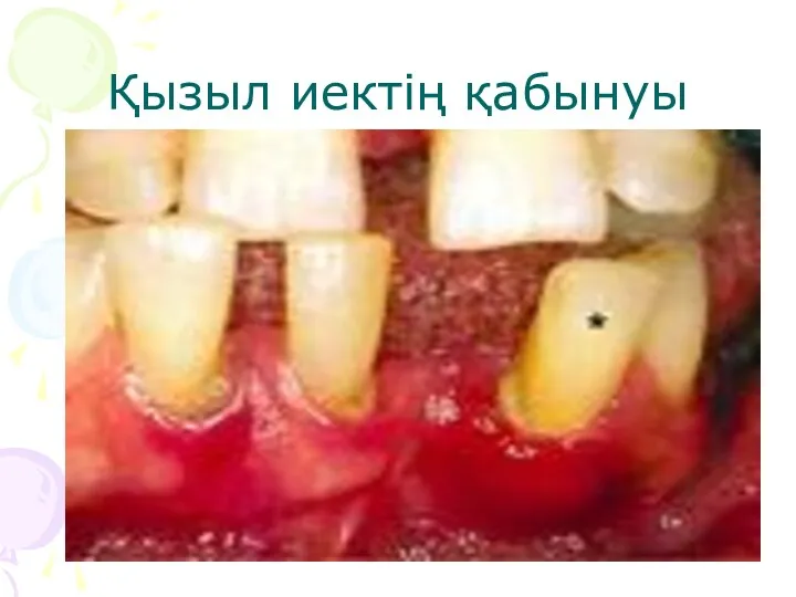 Қызыл иектің қабынуы