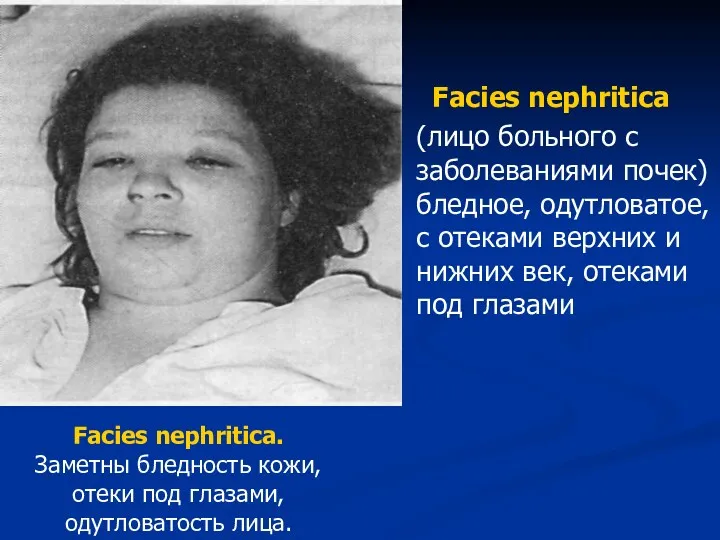 Facies nephritica (лицо больного с заболеваниями почек) бледное, одутловатое, с отеками верхних и