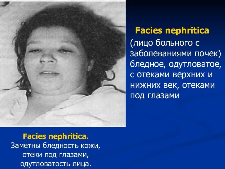 Facies nephritica (лицо больного с заболеваниями почек) бледное, одутловатое, с