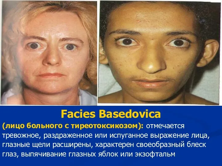 Facies Basedovica (лицо больного с тиреотоксикозом): отмечается тревожное, раздраженное или испуганное выражение лица,