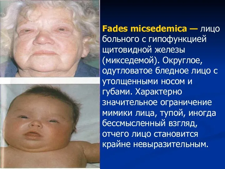 Fades micsedemica — лицо больного с гипофункцией щитовидной железы (микседемой). Округлое, одутловатое бледное