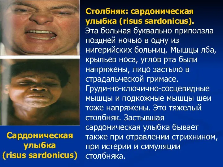 Столбняк: сардоническая улыбка (risus sardonicus). Эта больная буквально приползла поздней ночью в одну